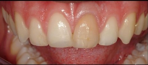 Restauration des dents