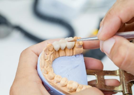 réalisation prothèse dentaire