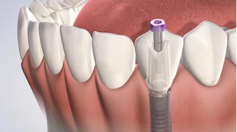 Pose d'implant dentaire : combien de temps ça dure ? nos réponses en dessous.